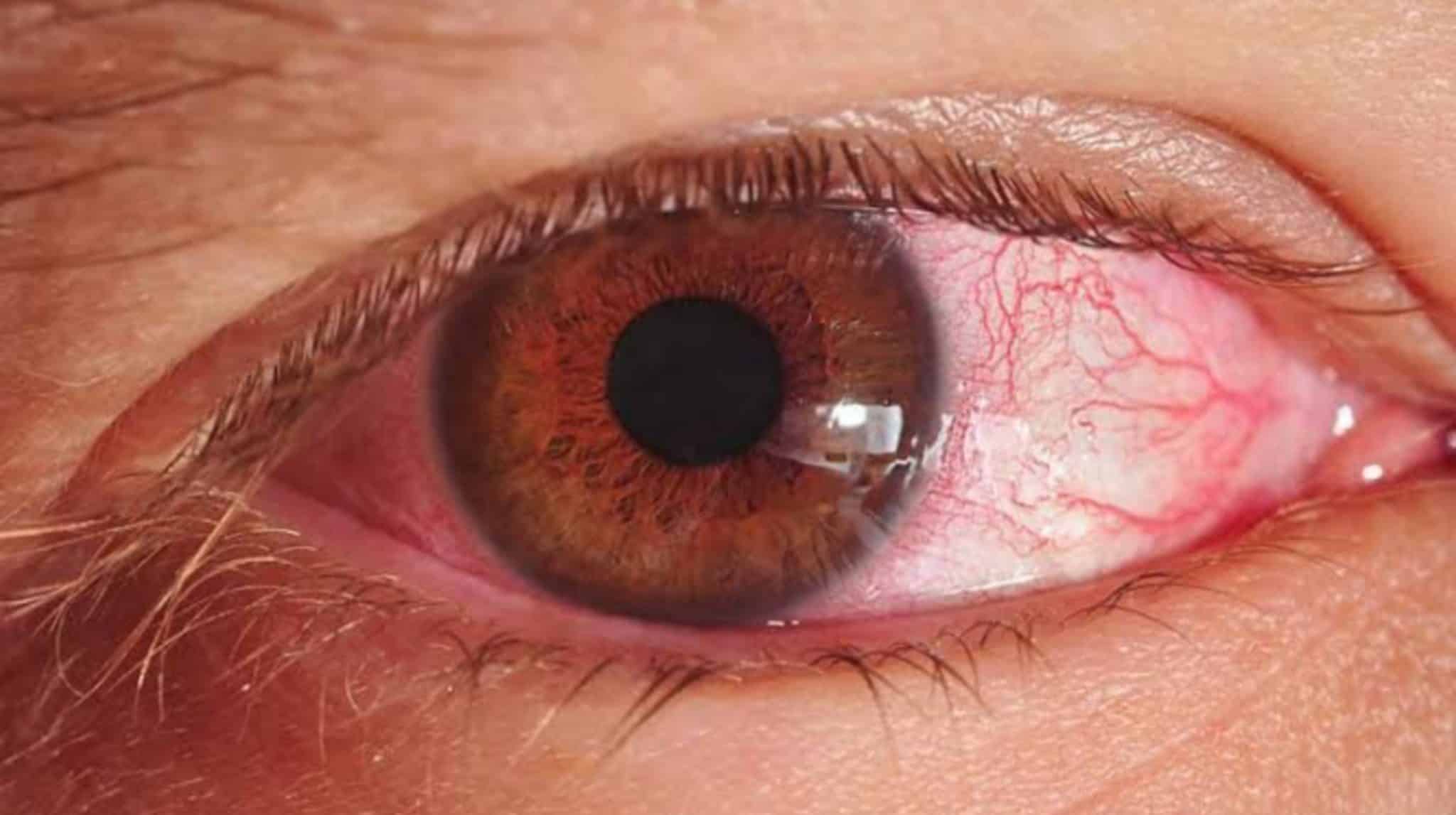 You are currently viewing Lahore Witnesses Alarming Surge in Contagious Pink-Eye Outbreak